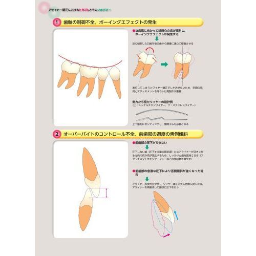 アライナー矯正のリカバリーテクニック