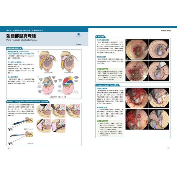 ＴＥＥＳ〈経外耳道的内視鏡下耳科手術〉手技アトラス　導入・基本手技からアドバンスまで