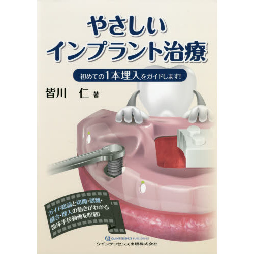 やさしいインプラント治療 初めての1本埋入をガイドします! やさしいインプラント治療 初めての1本埋入をガイドします