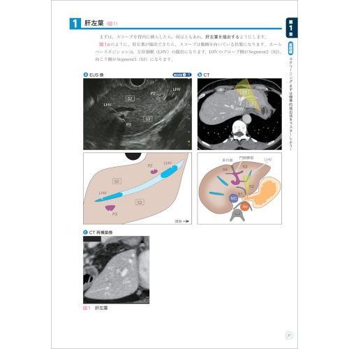 胆膵ＥＵＳセミナー　ＣＴ＋シェーマ＋動画と合わせてわかる手技の基本から治療まで