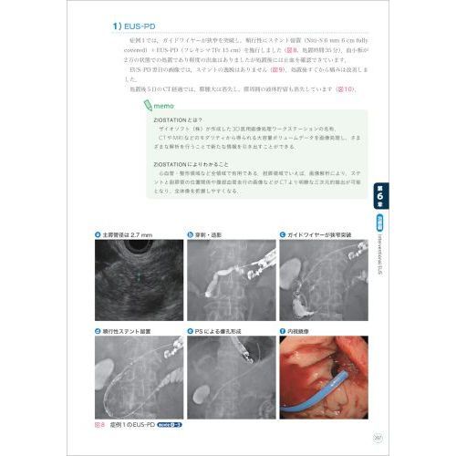 胆膵ＥＵＳセミナー　ＣＴ＋シェーマ＋動画と合わせてわかる手技の基本から治療まで