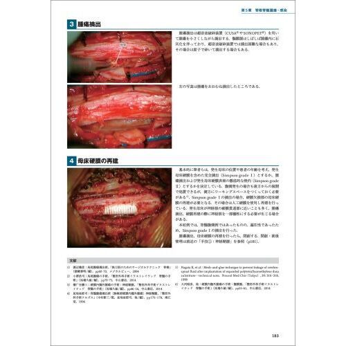 脊椎手術パーフェクト 術前準備から展開、除圧、固定、閉創まで