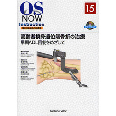 高齢者橈骨遠位端骨折の治療　早期ＡＤＬ回復をめざして