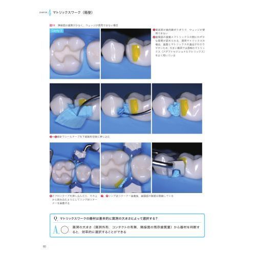 裁断済み】わかる!できる!決定版コンポジットレジン修復