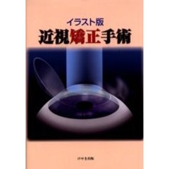 近視矯正手術　イラスト版