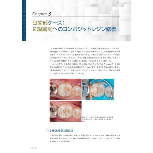 臨床に活かせるコンポジットレジン修復　レベルアップに必要なテクニックと勘所