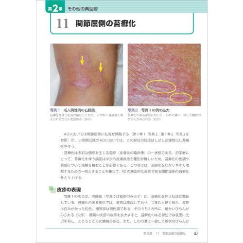 あらゆる診療科で役立つアトピー性皮膚炎アトラス 典型疹から間違え