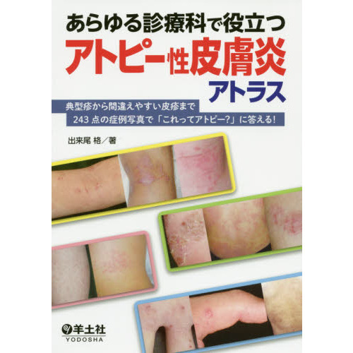 あらゆる診療科で役立つアトピー性皮膚炎アトラス 典型疹から間違え