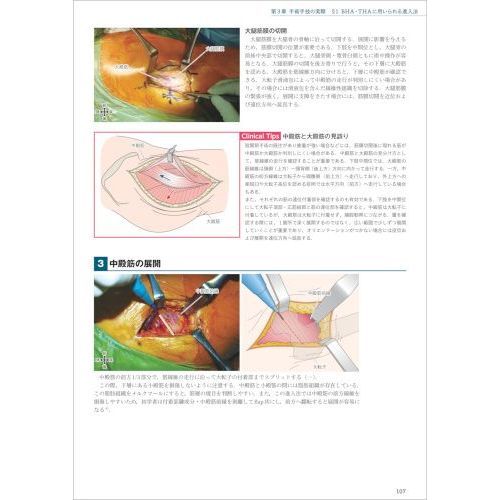 BHA・THA人工股関節置換術パーフェクト 人工骨頭置換術・人工