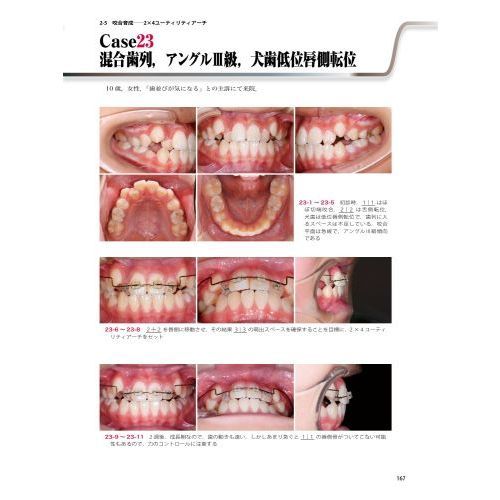 イラストと症例で学ぶ開業医のための臨床部分矯正 咬合育成から補綴前