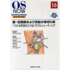 膝・足関節および足趾の骨切り術　ベストな手技のコツ＆トラブルシューティング