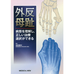 外反母趾　病態を理解し，正しい治療選択ができる