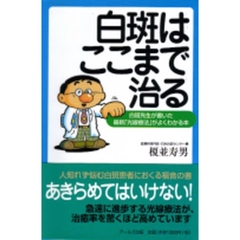 白斑はここまで治る　白斑先生が書いた最新「光線療法」がよくわかる本