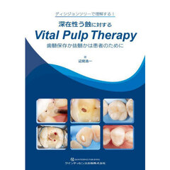 深在性う蝕に対するＶｉｔａｌ　Ｐｕｌｐ　Ｔｈｅｒａｐｙ　歯髄保存か抜髄かは患者のために　ディシジョンツリーで理解する！