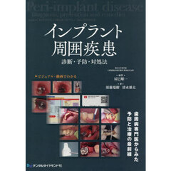 インプラント周囲疾患　診断・予防・対処法