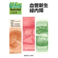 ＥＳ　ｎｏｗ　ｉｌｌｕｓｔｒａｔｅｄ　イラストでみる今日の眼科手術　１１　血管新生緑内障