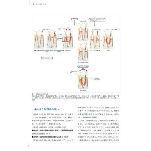 スカンジナビアンアプローチの実践 Ｄｒ．弘岡に訊く臨床的ペリオ講座