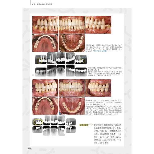 スカンジナビアンアプローチの実践　Ｄｒ．弘岡に訊く臨床的ペリオ講座