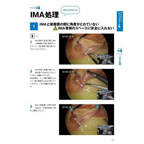 腹腔鏡下S状結腸切除術ハンズオントレーニング 動画でわかる徹底