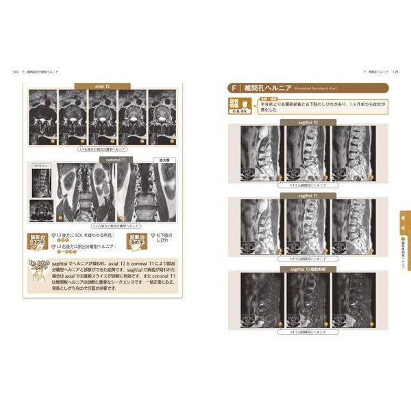 脊椎ＭＲＩ読影の一手　１９０５画像からみた定跡