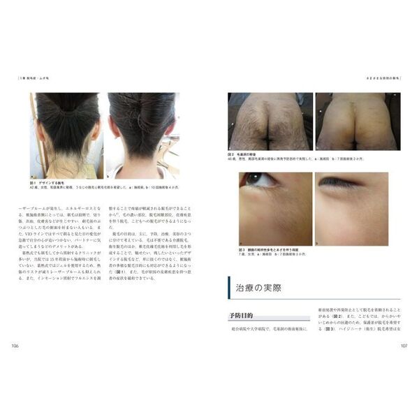 最新美容皮膚科学大系 5 脱毛・にきびの治療 美容皮膚科オール