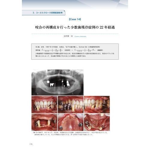 検証コーヌスクローネ : 長期経過症例と臨床統計からの再評価-