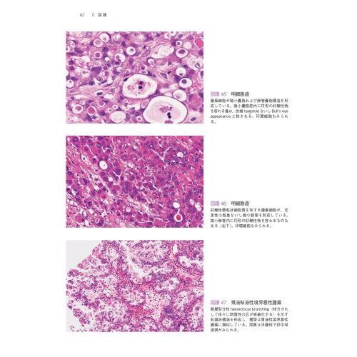 ください 卵巣腫瘍・卵管癌・腹膜癌取扱い規約 病理編：ぐるぐる王国