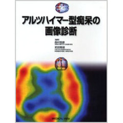 アルツハイマー型痴呆の画像診断