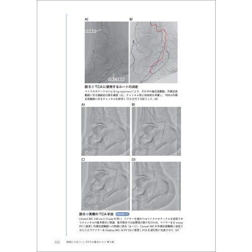 格段にうまくいくＥＶＴの基本とコツ　症例でわかるデバイスの選択・操作とトラブルシューティング　第３版