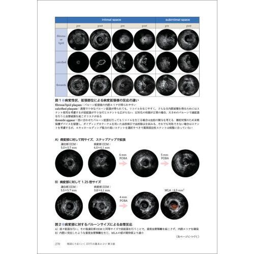 格段にうまくいくＥＶＴの基本とコツ　症例でわかるデバイスの選択・操作とトラブルシューティング　第３版