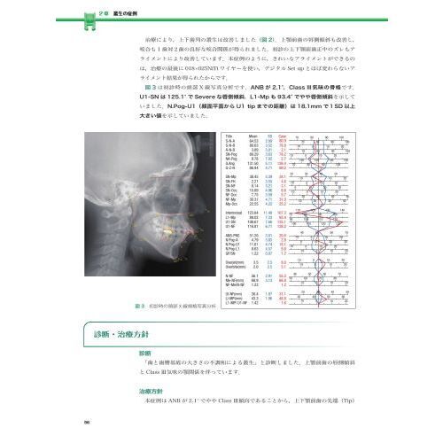 実践的リンガルブラケット矯正