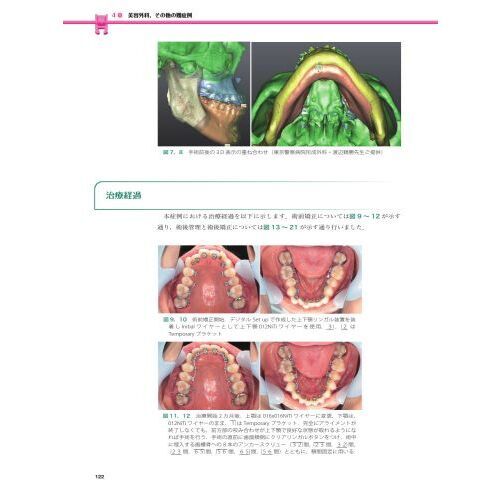 実践的リンガルブラケット矯正