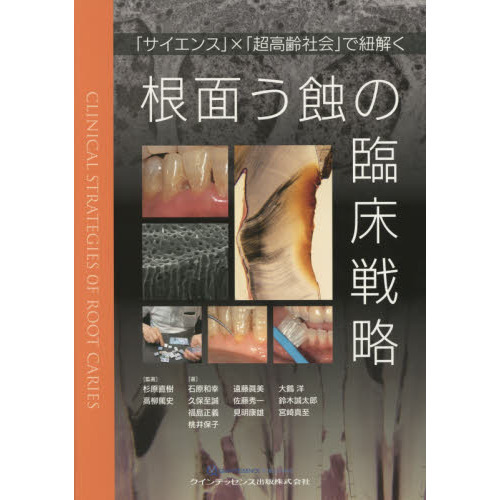 根面う蝕の臨床戦略 根面う蝕の臨床戦略 「サイエンス」×「超高齢社会」で紐解く